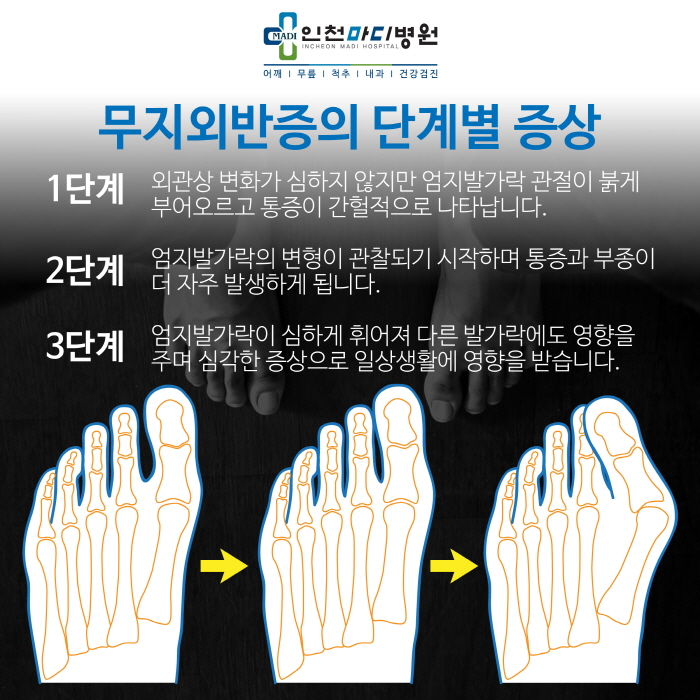 발가락의 변형과 통증 주요원인, 무지외반증