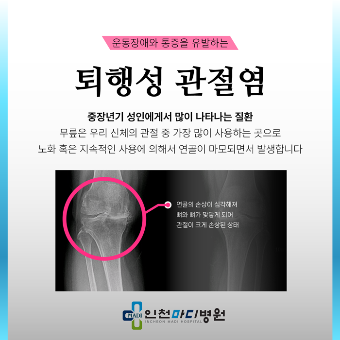 운동장애와 다리통증, '퇴행성 관절염' 치료는 어떻게 할 수 있을까요?