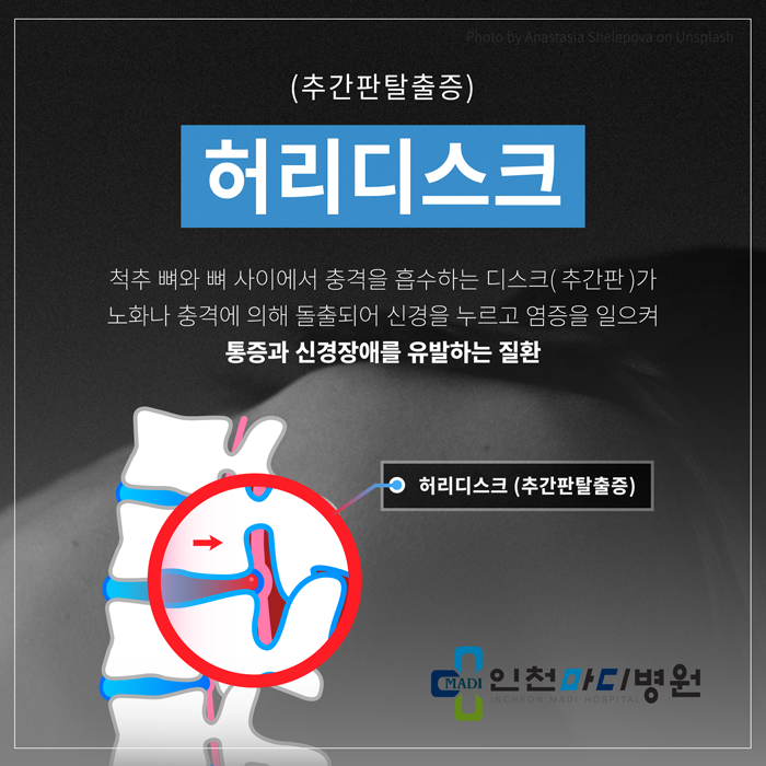 '허리디스크'는 반드시 수술해야 할까요?