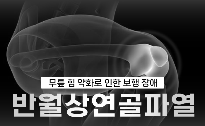 보행장애를 유발하는 반월상연골파열