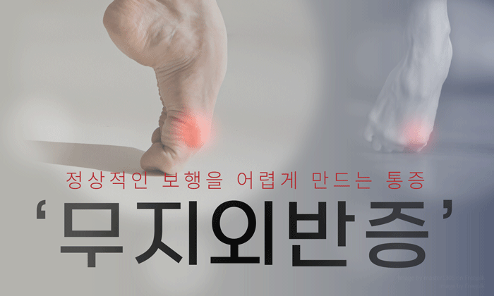 무지 외반증 증상 언제부터 치료하면 좋을까요?