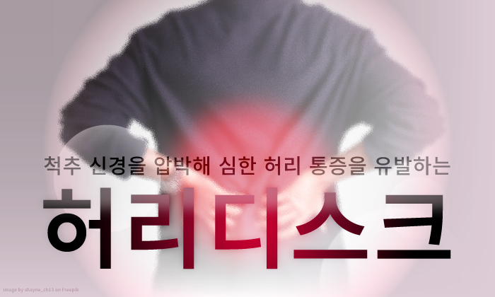 허리디스크 초기 증상과 원인, 치료법에 대해 알아보기