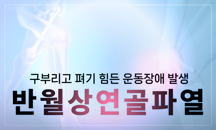 반월상연골파열, 수술이 필요한 때가 있습니다