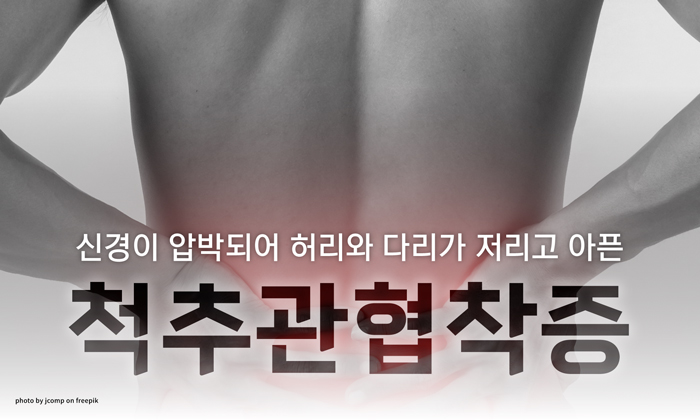 척추관협착증 증상, 비수술만으로도 치료가 가능할까