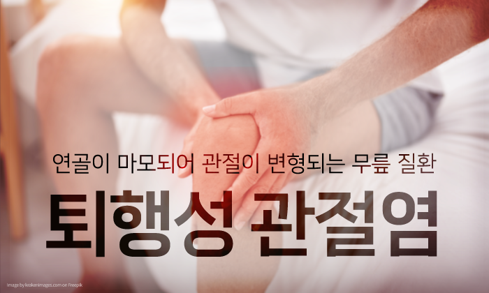 무릎 통증 일으키는 원인? 퇴행성관절염