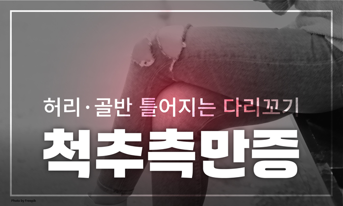 다리 꼬는 습관으로 인한 골반 뒤틀림과 척추측만증
